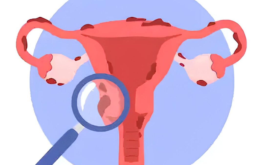 uterus endometriose